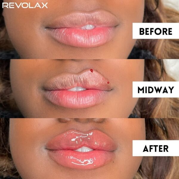 Revolax filler benefits