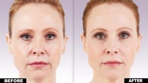 Juvederm fillers buy online