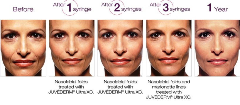 Juvederm fillers buy online