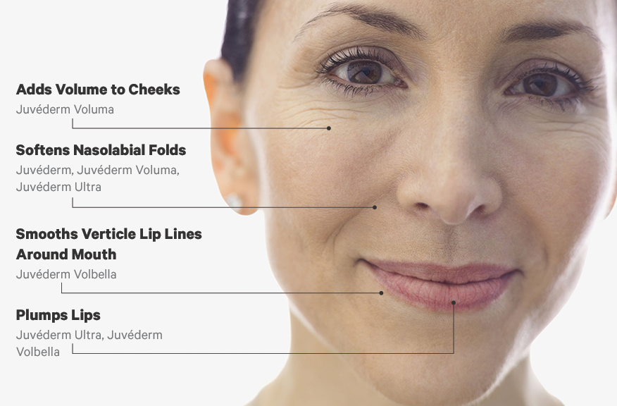 Juvederm fillers buy online